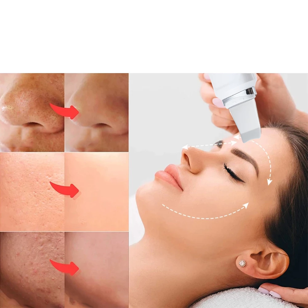 Urządzenie Ultradźwiękowe do oczyszczania skóry twarzy - obrazek 2